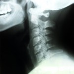 To Fuse or Not to Fuse, a Surgical Discussion on Cervical Radiculopathy